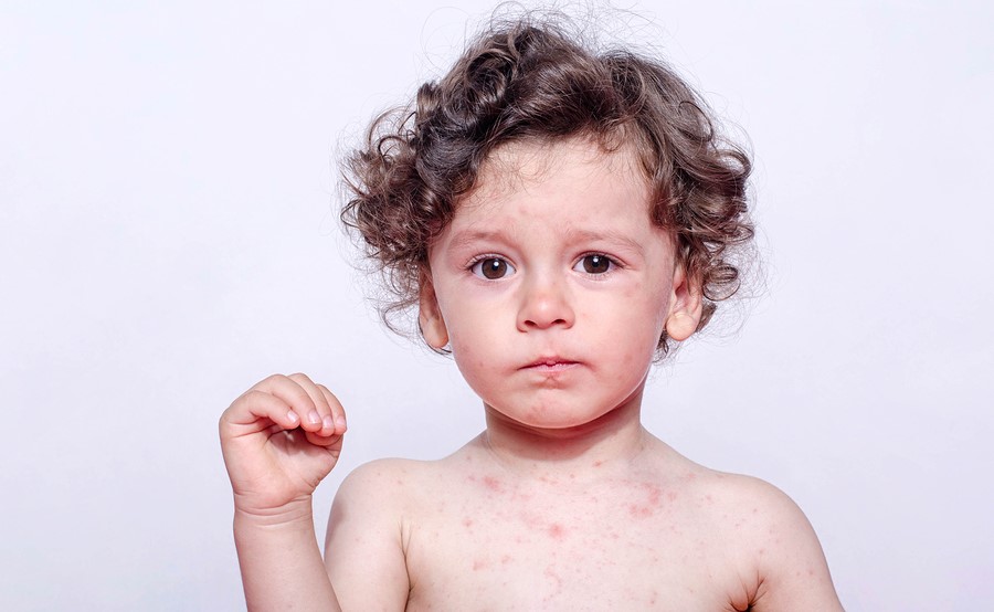 Hoe herken je een allergische reactie bij baby's en kinderen?