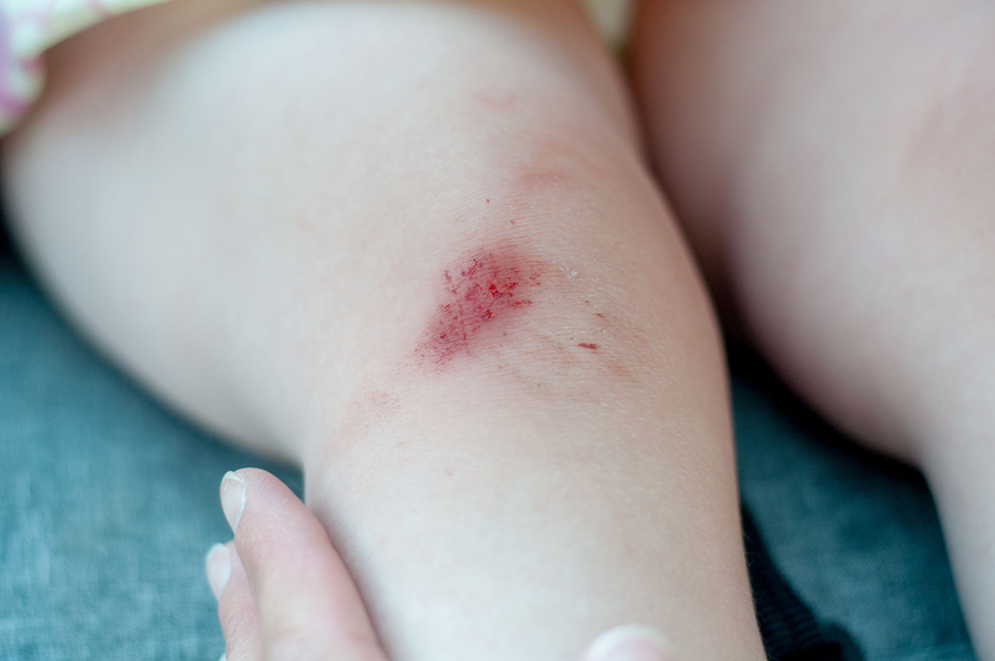 Wat moet je doen bij een schaafwond?